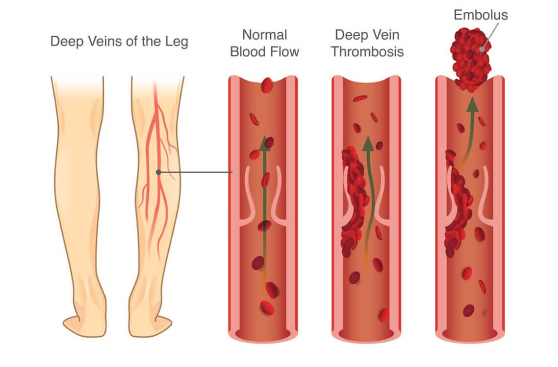 Deep Vein Thrombosis (DVT): Symptoms, Treatments, and Prevention