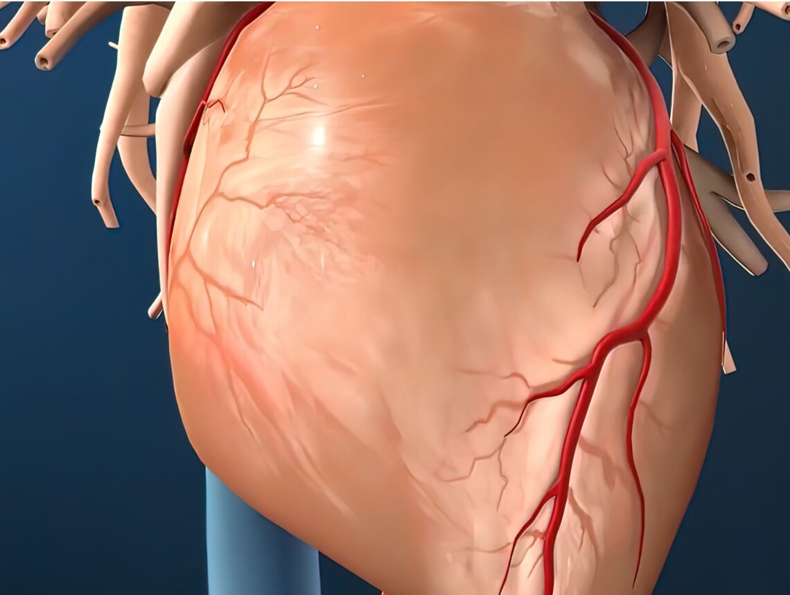 Coronary Artery Fistula in Children