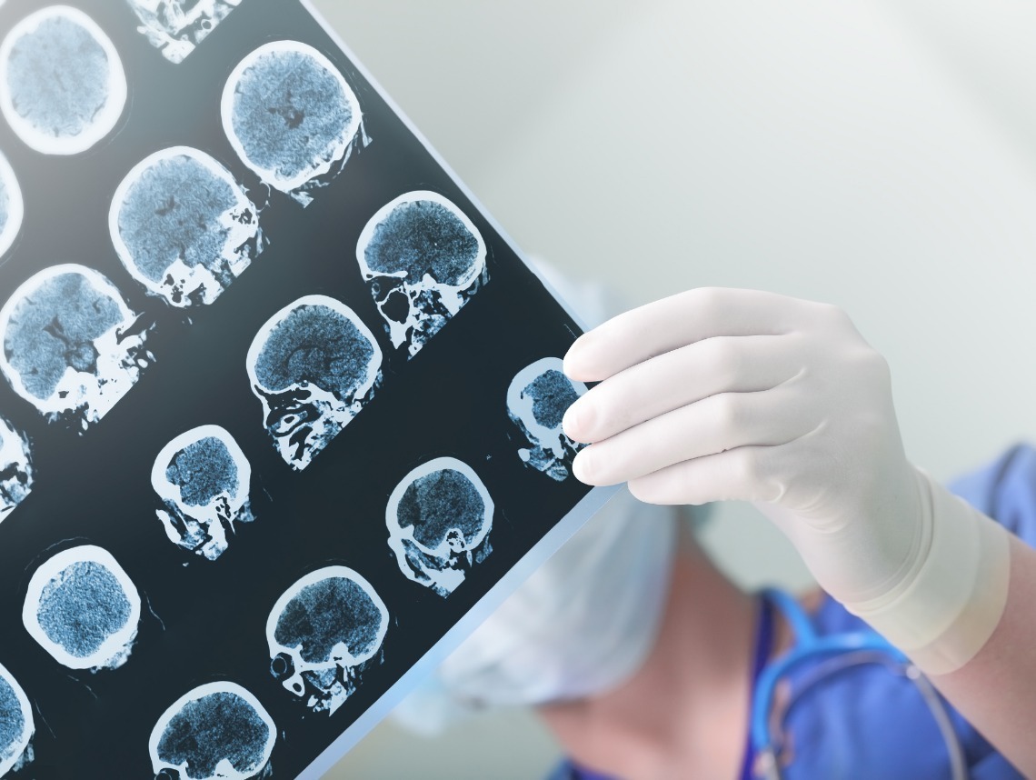 Early Warning Signs of a Stroke