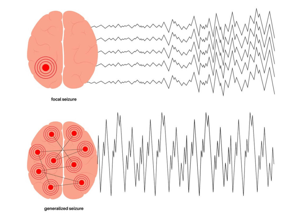 Focal vs Generalized Seizures