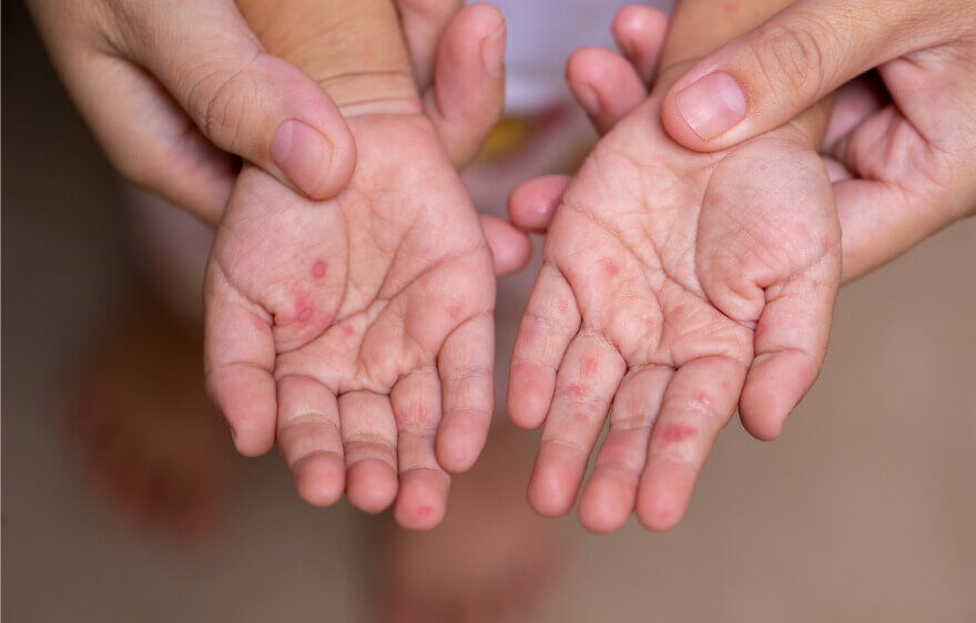 Hand Foot and Mouth Disease