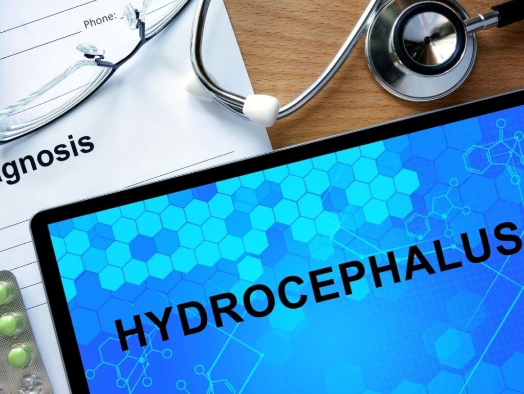 Hydrocephalus: Causes, Symptoms, and Treatment