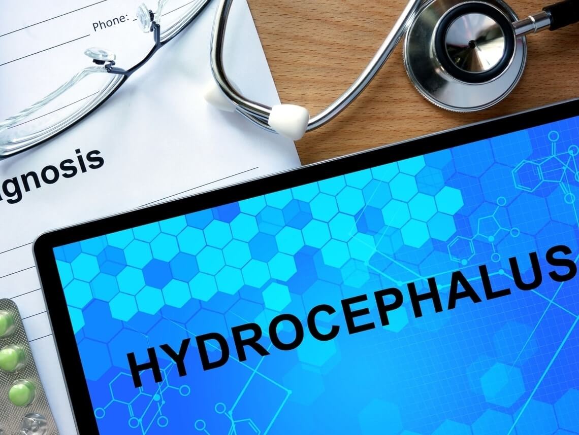 Hydrocephalus: Causes
