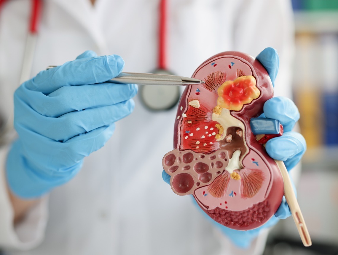 Hydronephrosis in Children