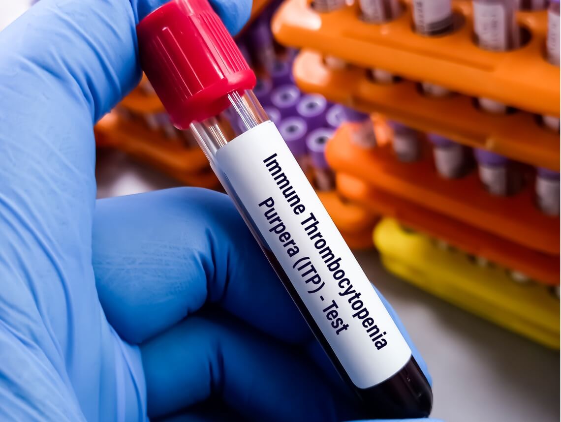 Idiopathic Thrombocytopenic Purpura in Children