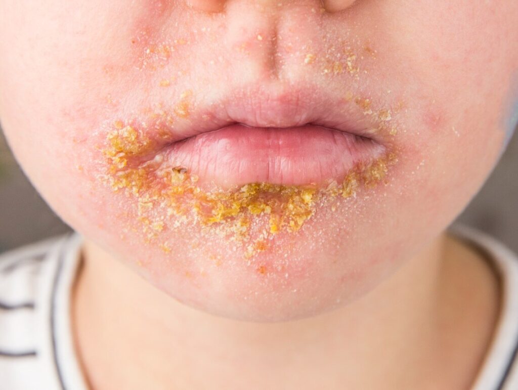 Impetigo in Children