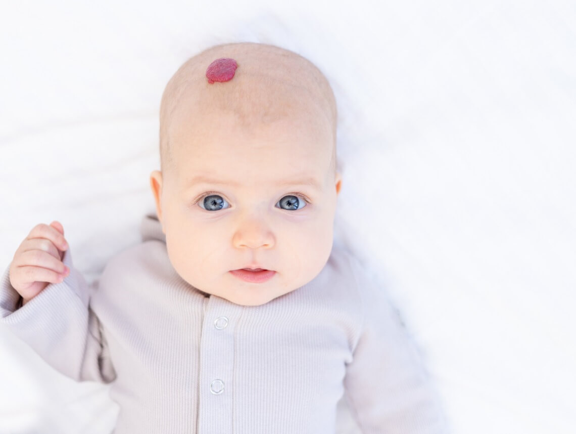 Infantile Hemangioma
