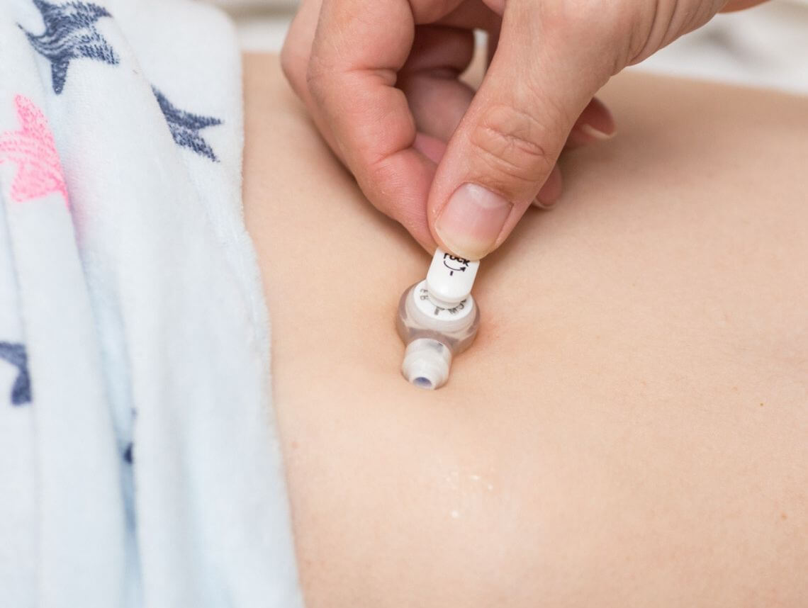 Jejunostomy (J-Tube)