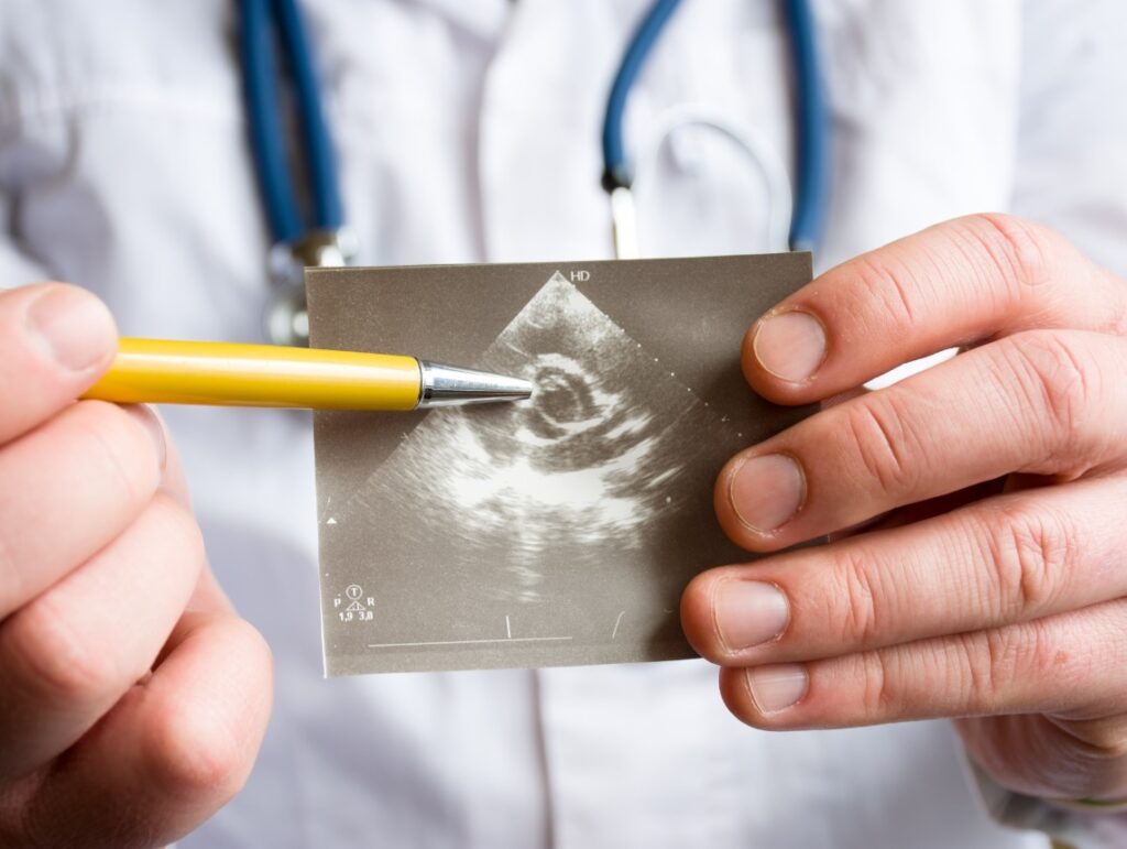 Mitral Valve Stenosis