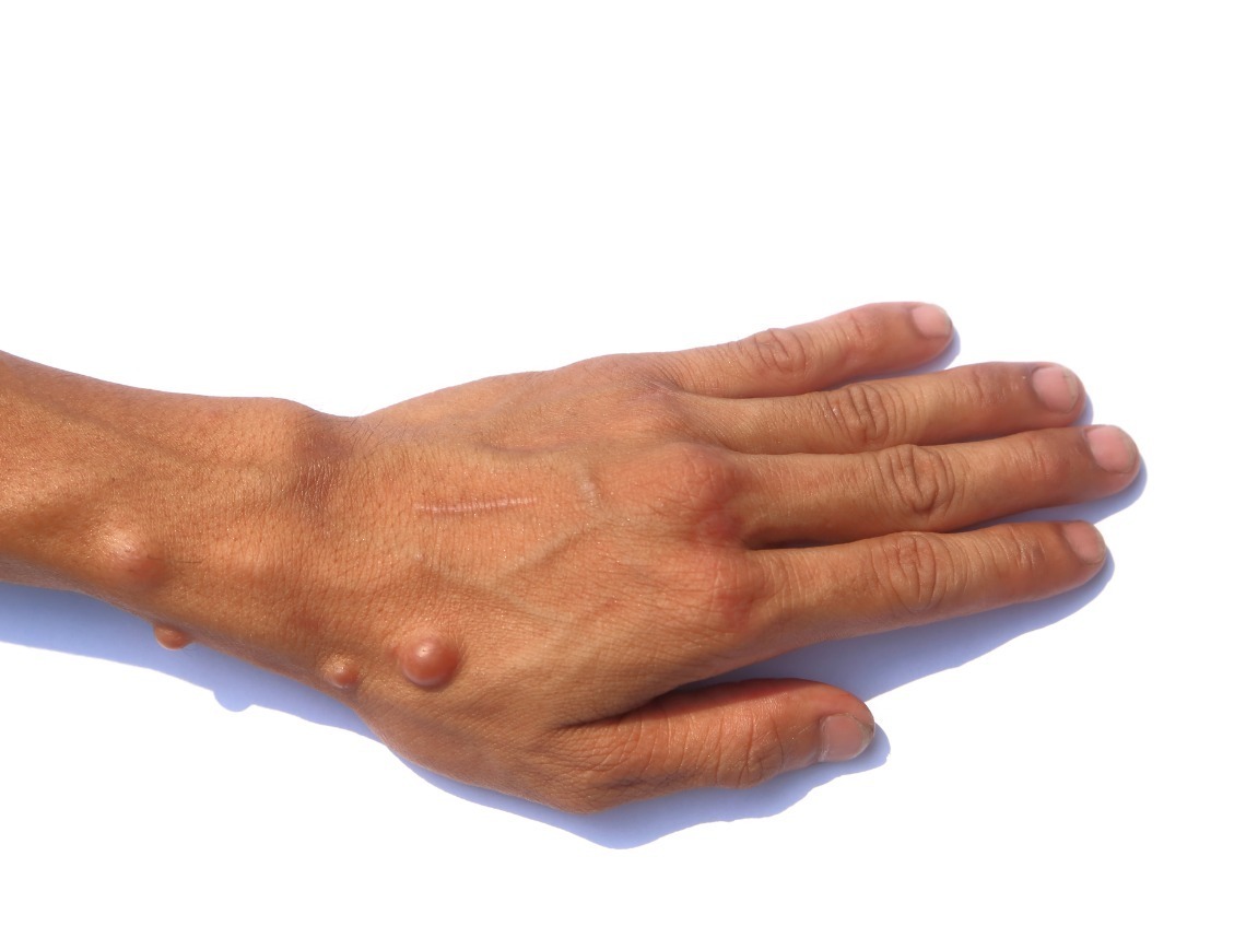 Neurofibromatosis