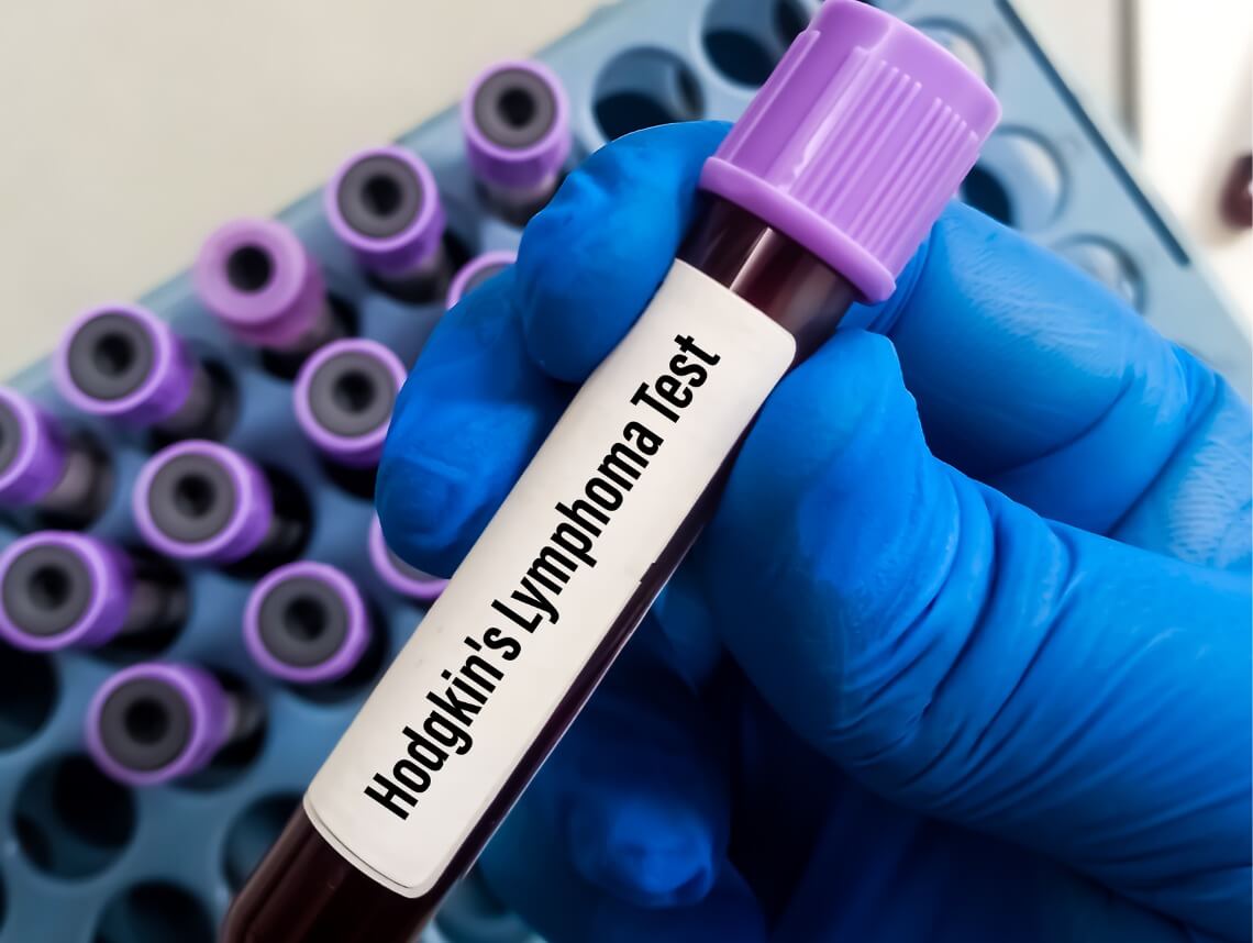 Non-Hodgkin Lymphoma in Children