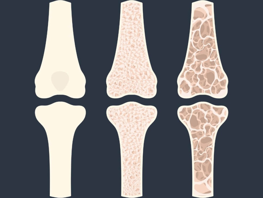 Osteogenesis Imperfecta in Children
