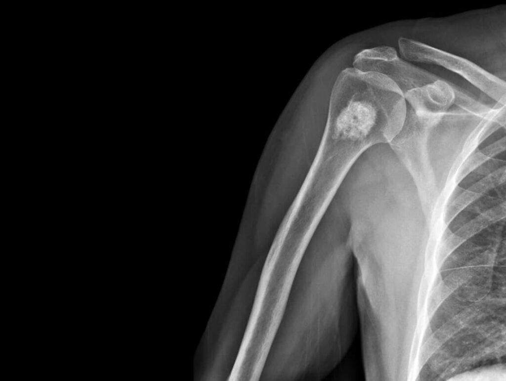 Pediatric Osteochondroma