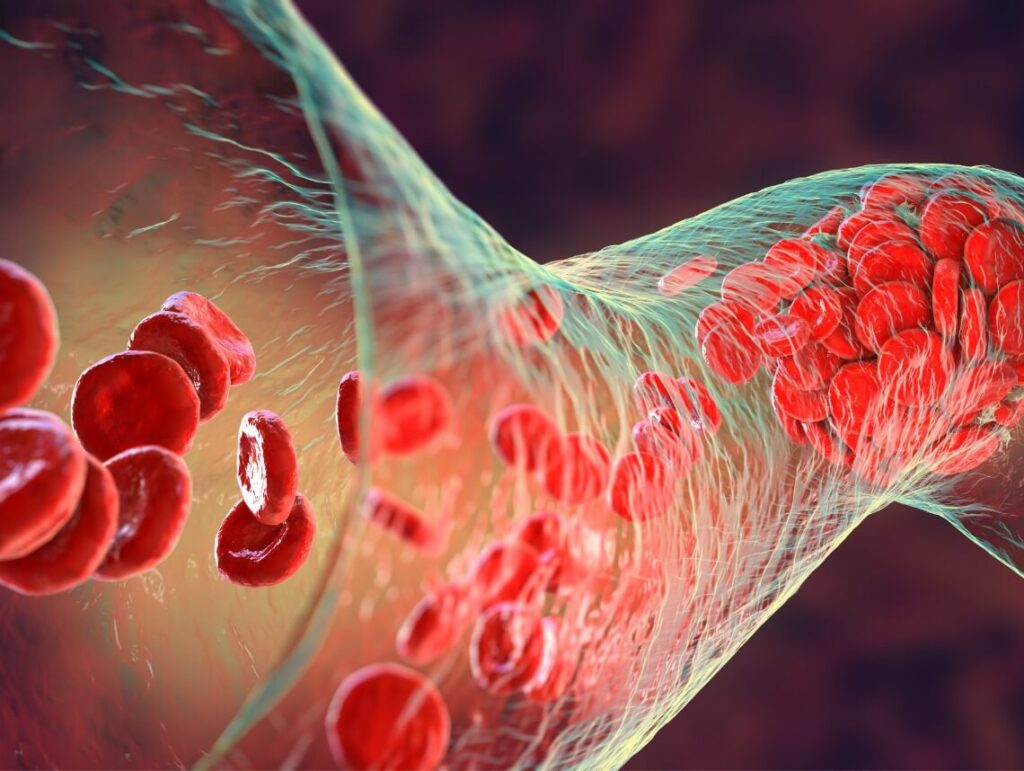 Pediatric Thrombosis: Blood Clots in Children