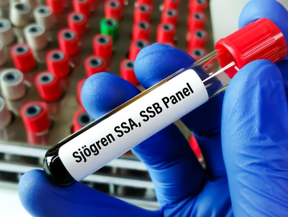 Sjogren’s Syndrome in Children