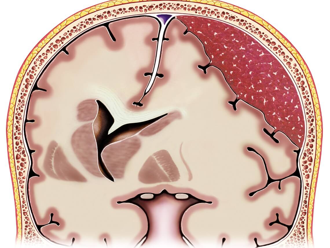 Subdural Hematoma in Children