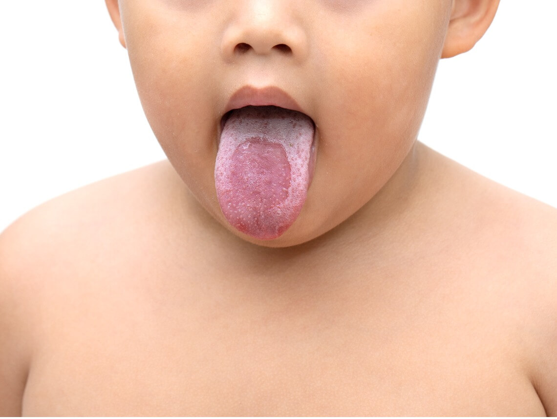 Thrush in Babies