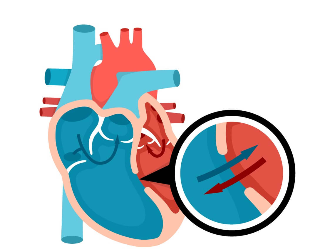 Ventricular Septal Defect in Children