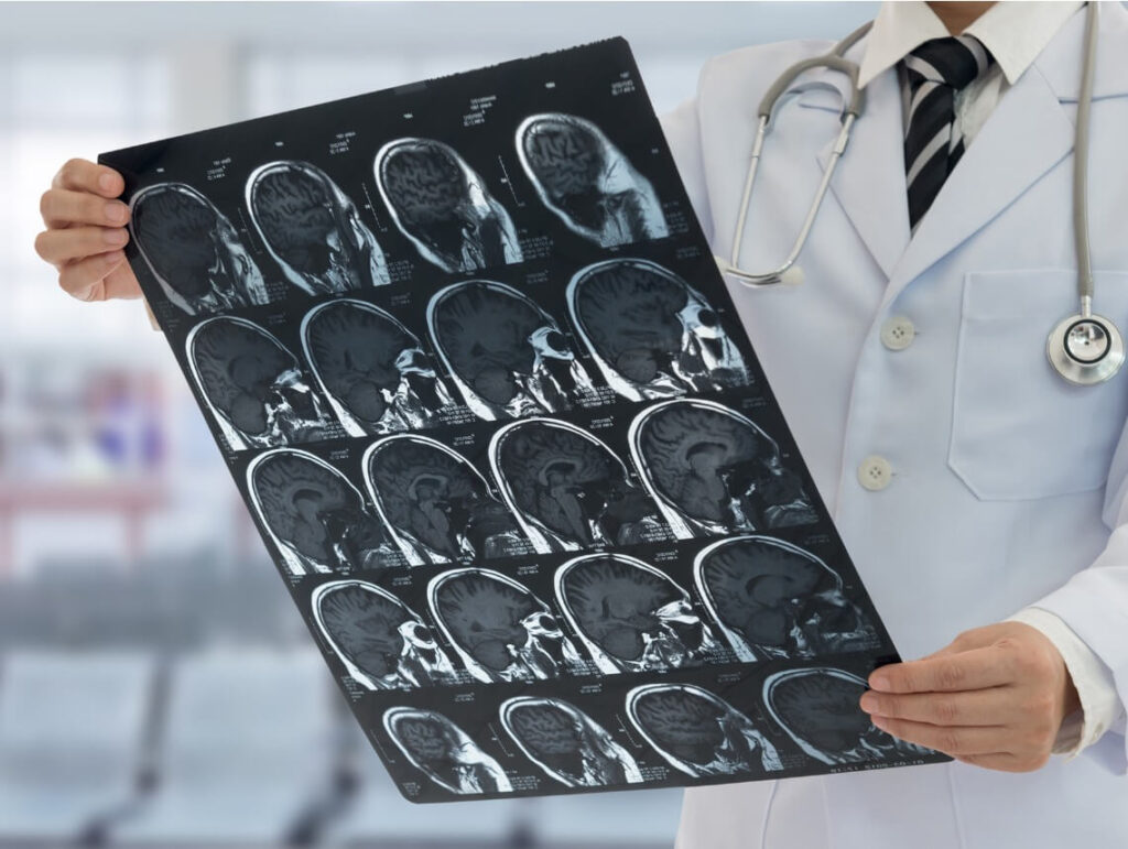 What Is Multiple System Atrophy?