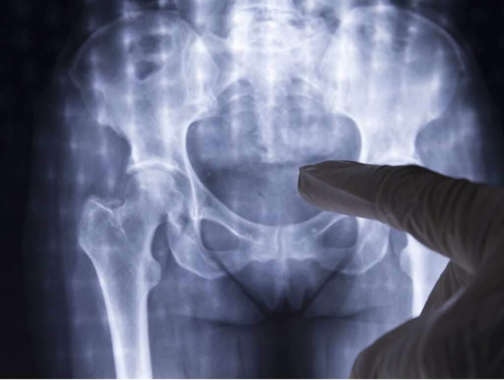 What Is Paget’s Disease of Bone?