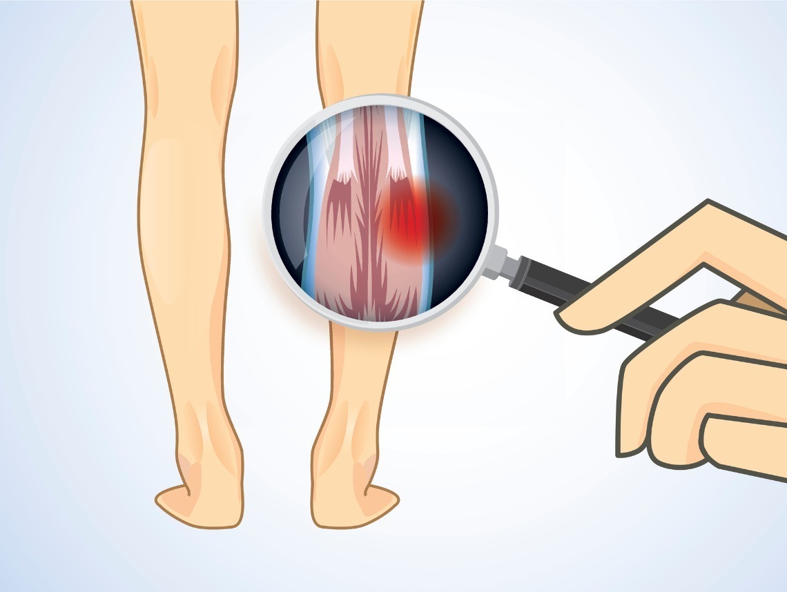 What is Spinal Muscular Atrophy?