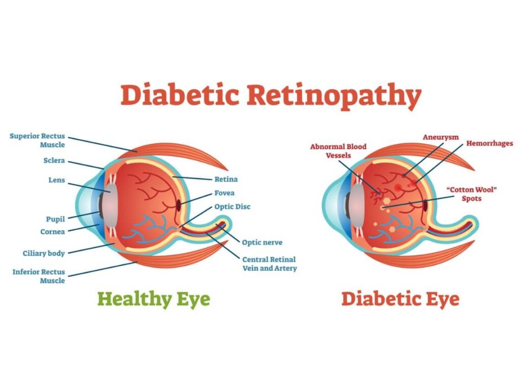 Diabetic Retinopathy