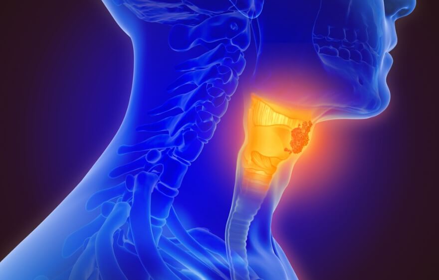 Vocal Cord Paralysis